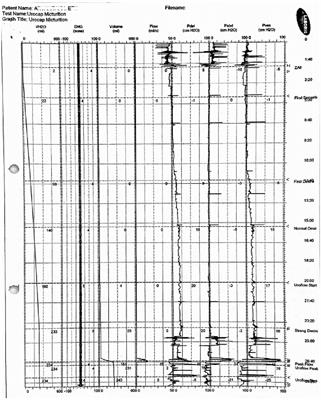 Case Report: Sacral Nerve Root Pelvic Neural Retraining, With Long-Term Sustainability After the Device Explantation
